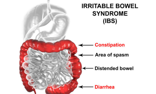 IBS Patients Face Higher Risk of Developing IBD, suggests study IBS Patients Face Higher Risk of Developing IBD, suggests study