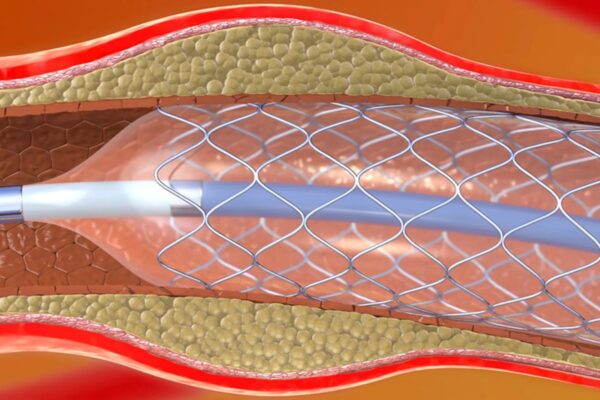TyG and TyG-BMI Indices Predict NAFLD Risk in PCI Patients: Study