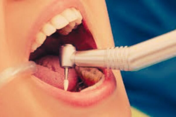 MA-T Shows Potential as Safer, Effective Root Canal Irrigant compared to sodium hypochlorite: Study