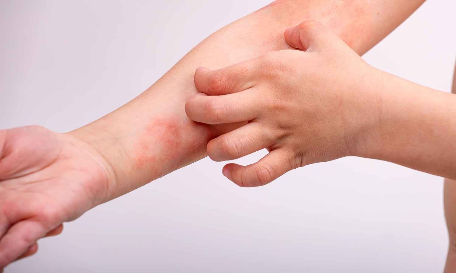 Ivarmacitinib Shows Rapid, Sustained Efficacy in Moderate-to-Severe Atopic Dermatitis: Study