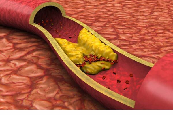 Pregnant women with preexisting high cholesterol may have elevated CV risk, reveals study