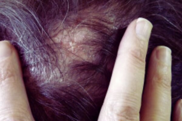 Intralesional Triamcinolone Outperforms Methotrexate in Alopecia Areata, suggests research