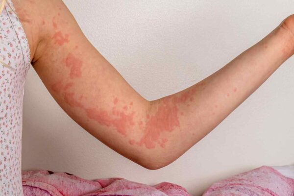 FDA Approves Oral Remibrutinib as First BTK Inhibitor for Chronic Spontaneous Urticaria