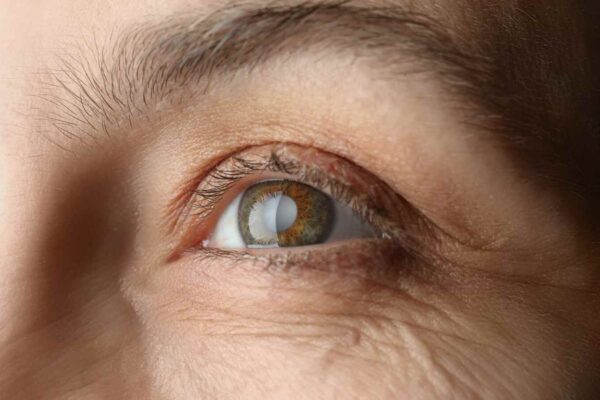Long-term Steroid Use for Vernal Keratoconjunctivitis Increases Glaucoma Risk: Study