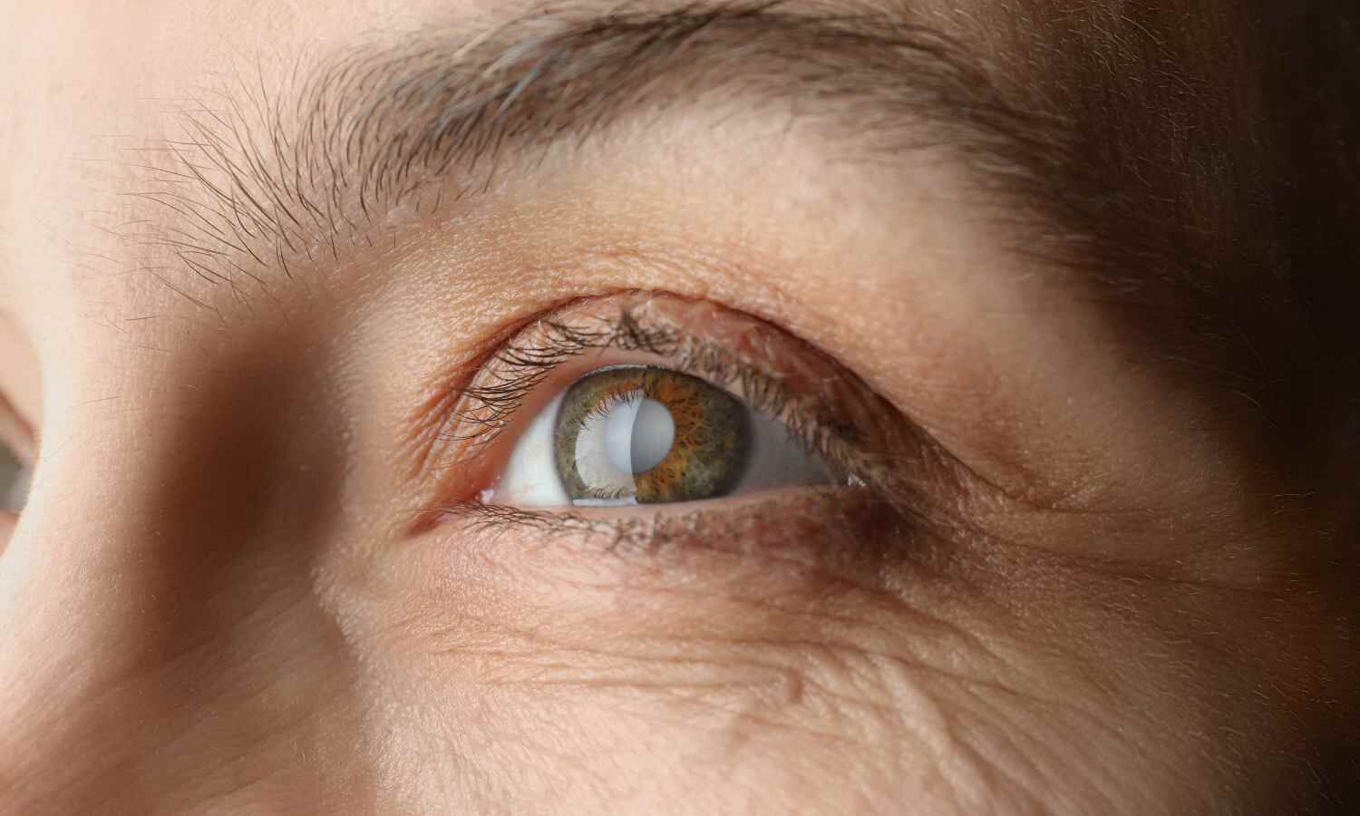 Long-term Steroid Use for Vernal Keratoconjunctivitis Increases Glaucoma Risk: Study