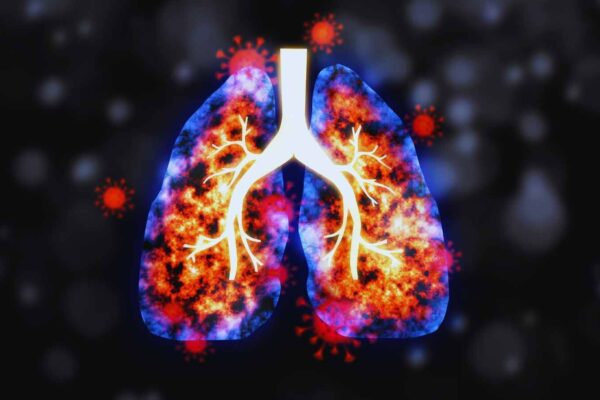 Rheumatoid arthritis-associated lung disease significantly increase risk of serious infection: Study