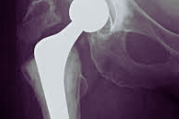 Starting Osteoporosis Medication After Hip Fracture Halves Risk of Implant-Related Breaks: Study Suggests