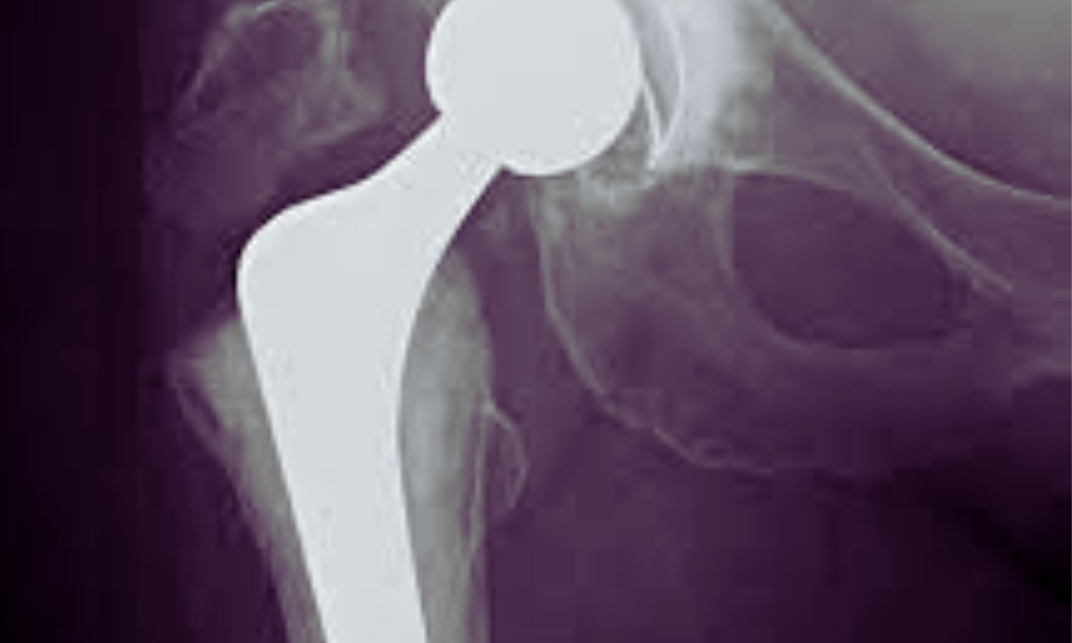 Starting Osteoporosis Medication After Hip Fracture Halves Risk of Implant-Related Breaks: Study Suggests