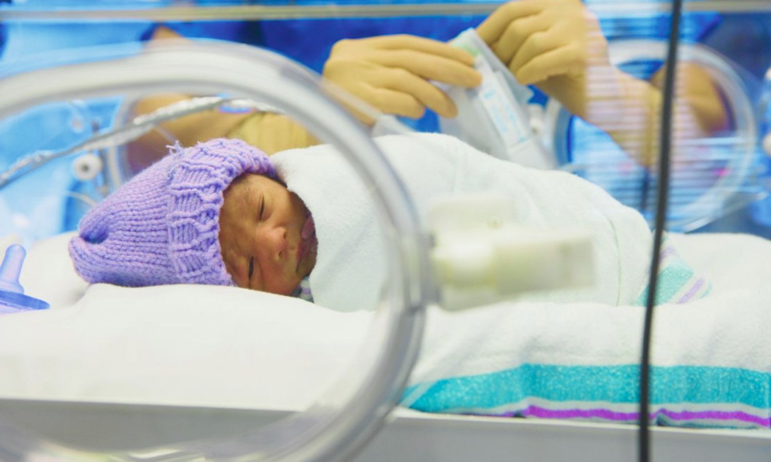AI-Driven Model Predicts Which Preterm Infants Benefit From Platelet Transfusions?