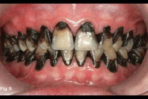 SDF Treatment Superior in Arresting Early Approximal Caries: Study