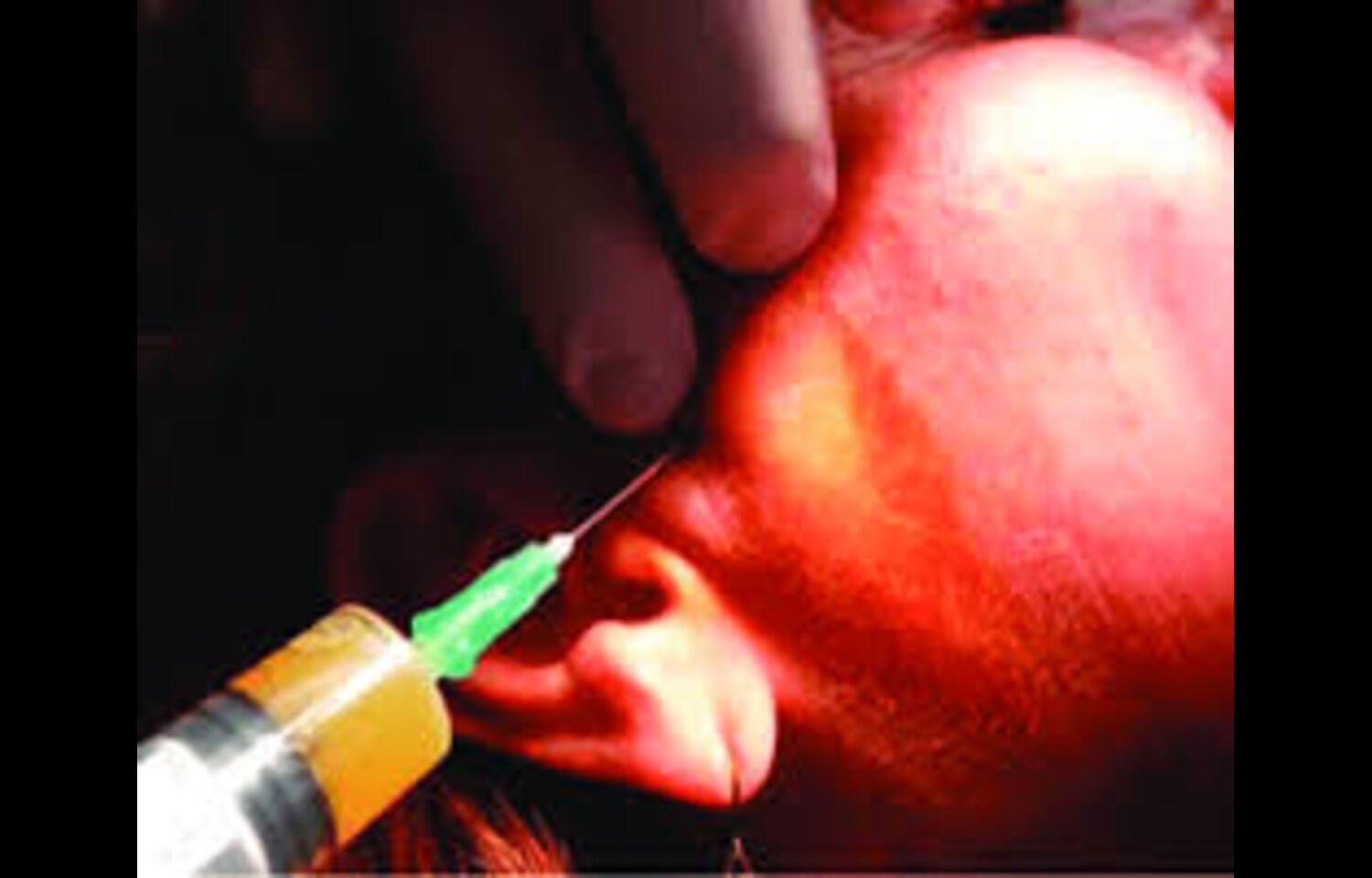Individualized approach for intra-Articular Injections effective for TMJ Arthralgia, suggests study