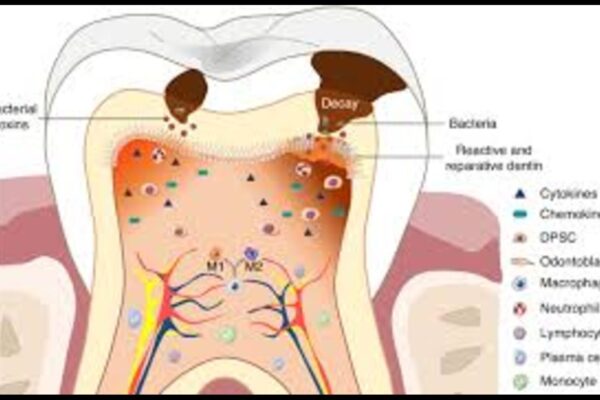 Partial Radicular Pulpotomy Viable Treatment for Symptomatic Irreversible Pulpitis in Mature Permanent Molars: Study