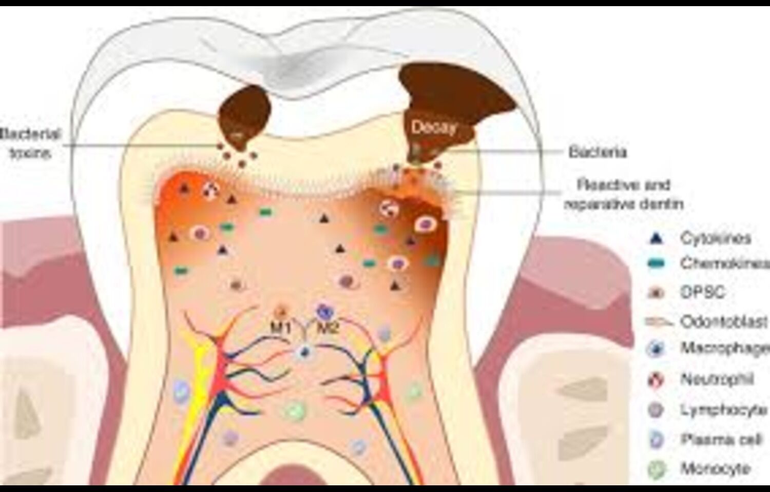 Partial Radicular Pulpotomy Viable Treatment for Symptomatic Irreversible Pulpitis in Mature Permanent Molars: Study