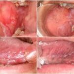 Curcumin Lozenges Show Promise in Managing Oral Lichen Planus, reveals study