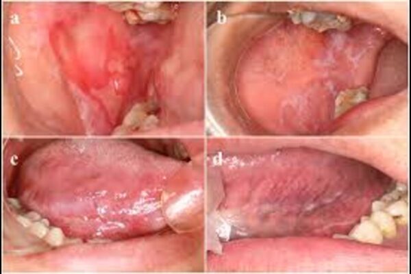 Curcumin Lozenges Show Promise in Managing Oral Lichen Planus, reveals study