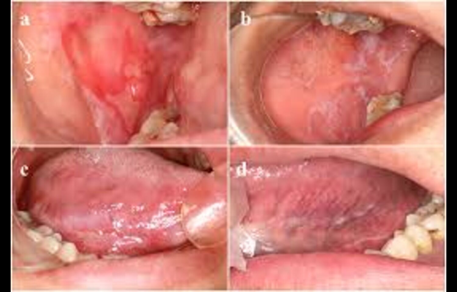 Curcumin Lozenges Show Promise in Managing Oral Lichen Planus, reveals study