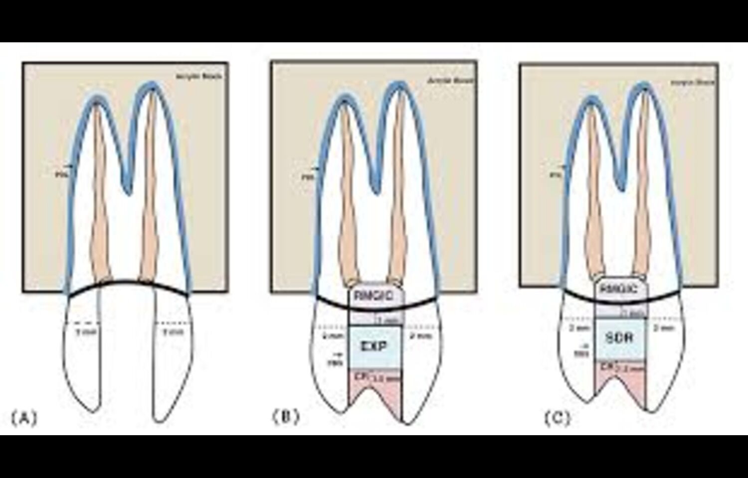 Fiber-Reinforced Restorations Improve Fracture Resistance in Endodontically Treated Teeth: Study