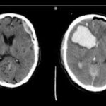 Surgical and Conservative Approaches have Comparable Outcomes in patients with acute subdural hematoma: JAMA