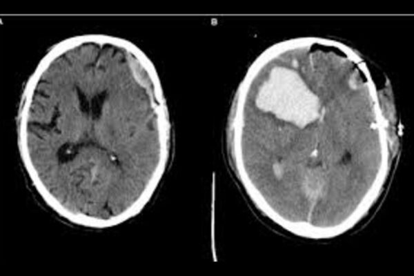 Surgical and Conservative Approaches have Comparable Outcomes in patients with acute subdural hematoma: JAMA
