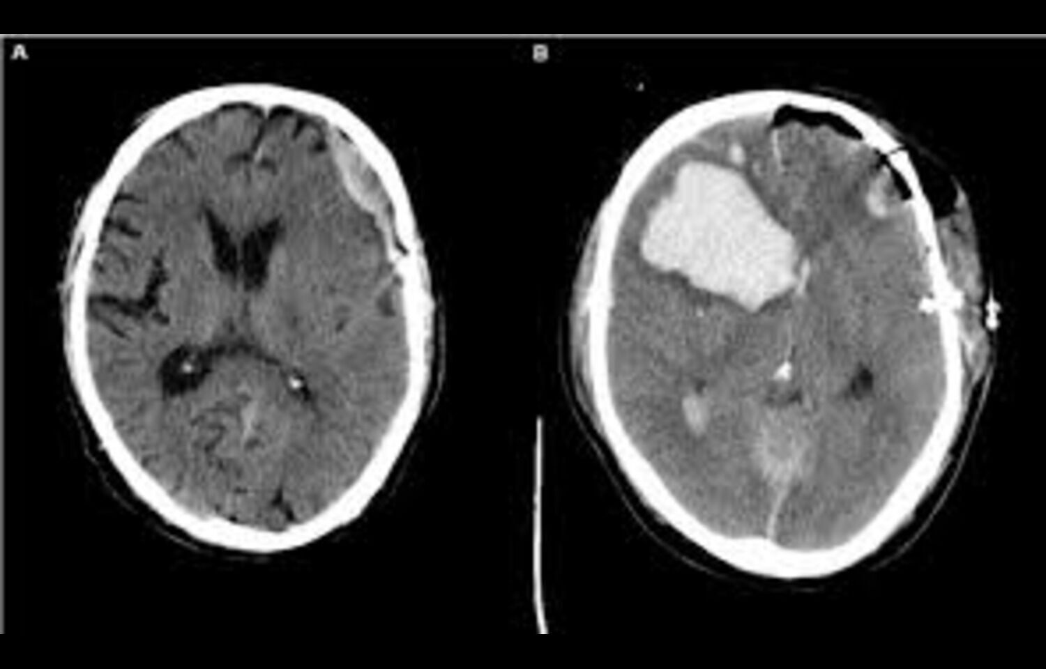 Surgical and Conservative Approaches have Comparable Outcomes in patients with acute subdural hematoma: JAMA