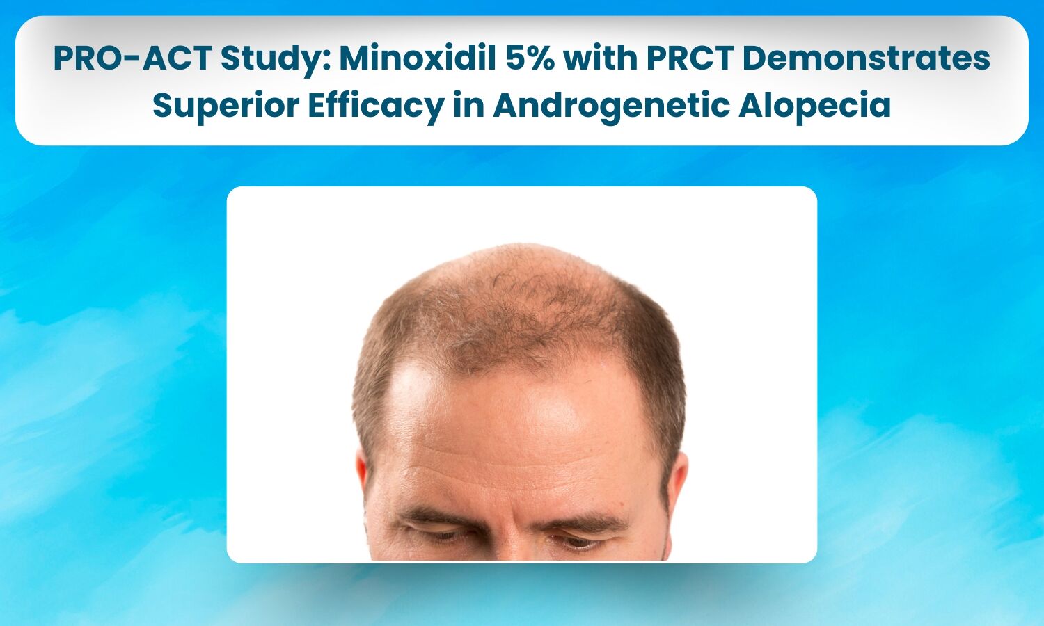 PRO-ACT Study Compares Topical Minoxidil 5% with PRCT vs Plain Minoxidil 5% in Androgenetic Alopecia–Combination Shows Superior Efficacy