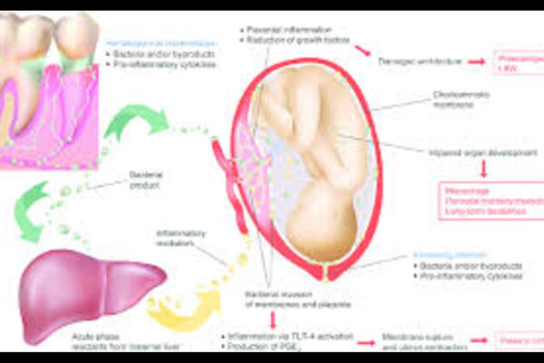 Poor Periodontal Health Linked to GDM in Pregnant Women: Study