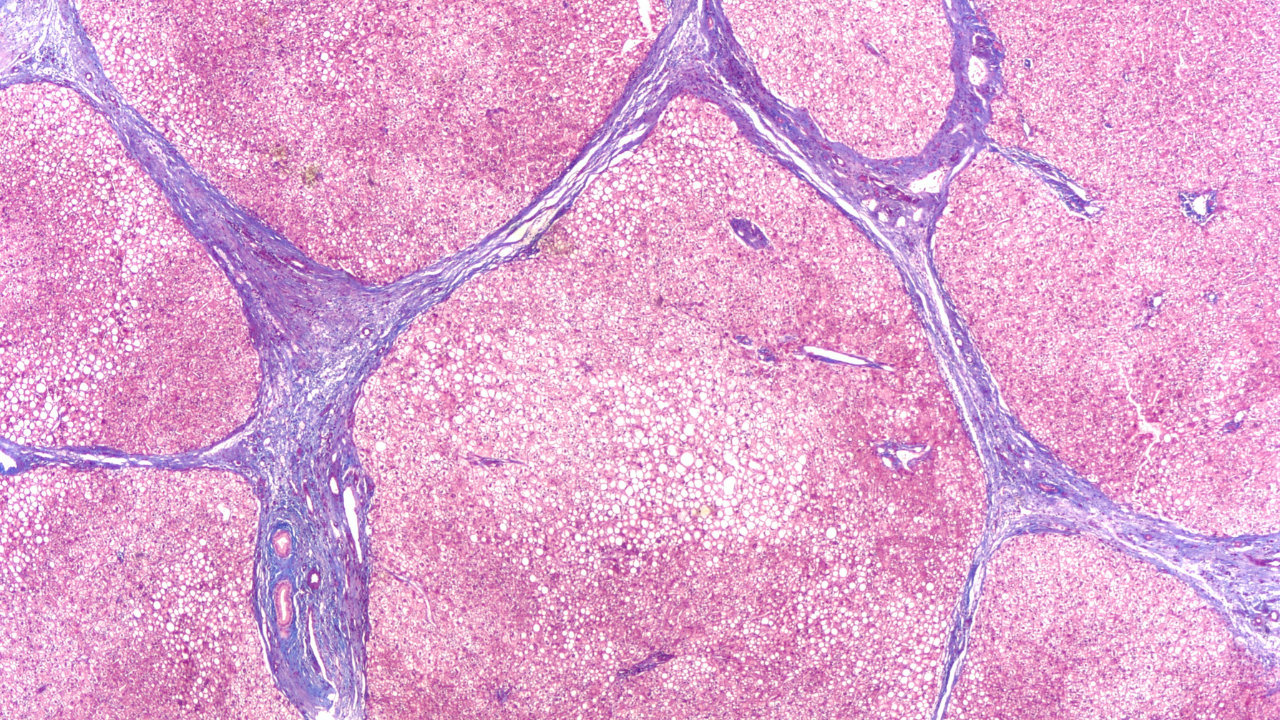 FDA Approves Jascayd for Idiopathic Pulmonary Fibrosis Treatment
