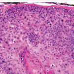 Regeneron’s Libtayo stakes out new territory in skin cancer