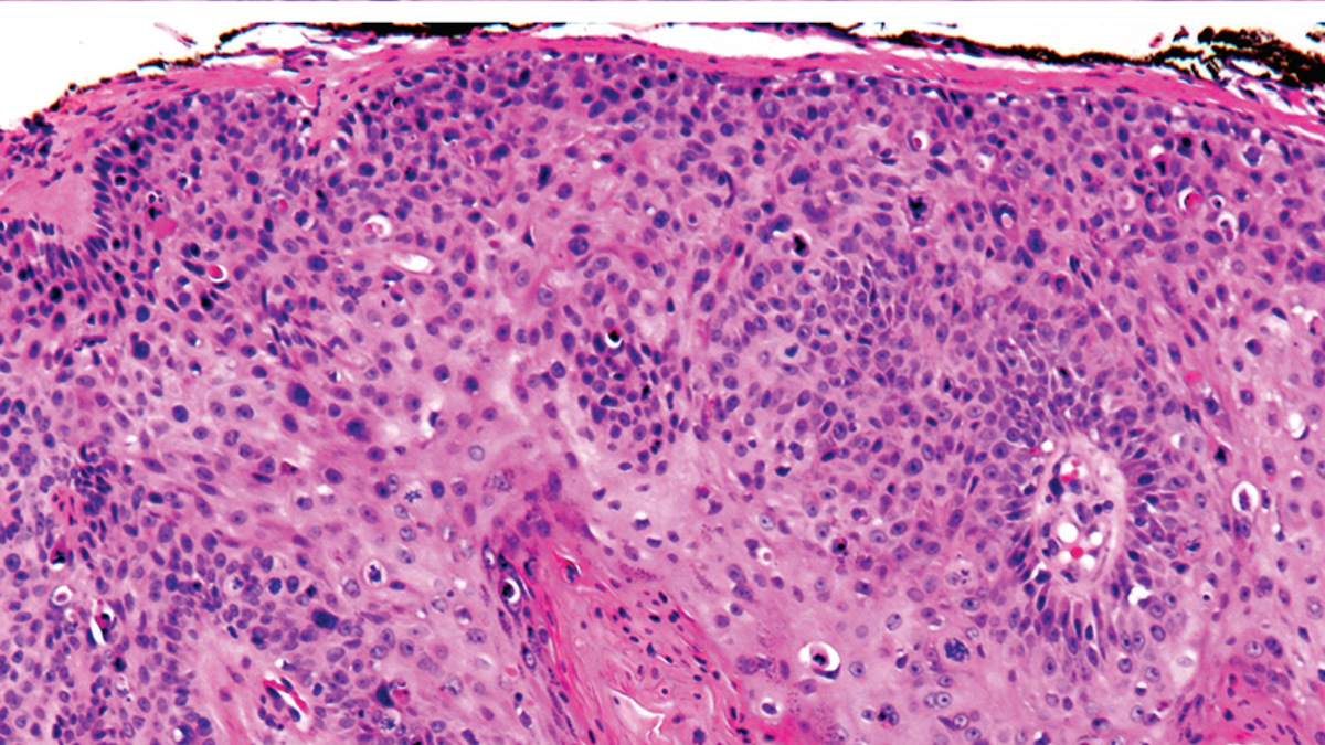 Regeneron’s Libtayo stakes out new territory in skin cancer
