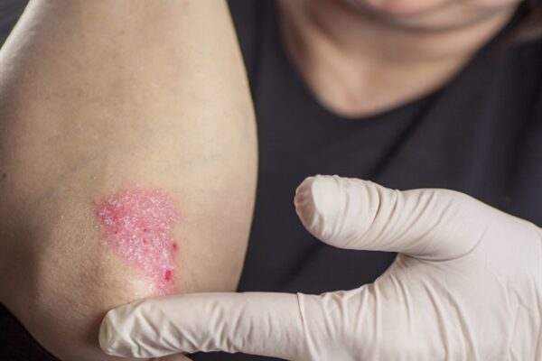 Stressful life factors early in life may triple the risk of developing psoriasis later
