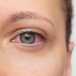 Dry Eye in Duluth: Why It Happens and What You Can Do