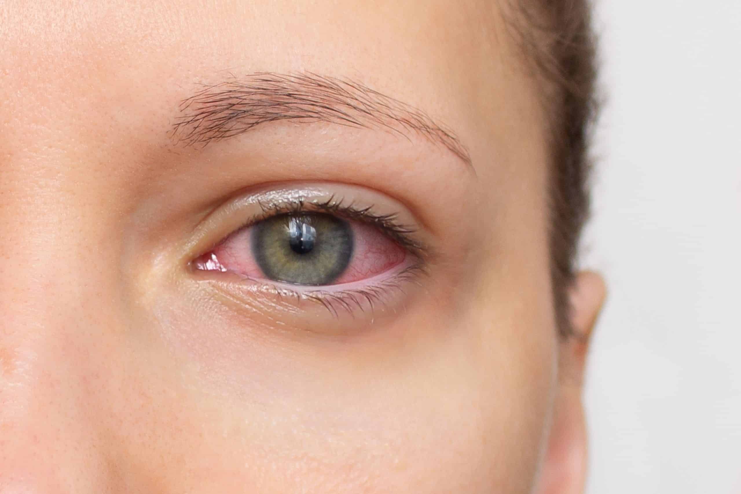 Dry Eye in Duluth: Why It Happens and What You Can Do