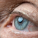 Cataract surgery leads to ‘transient’ macular changes in AMD