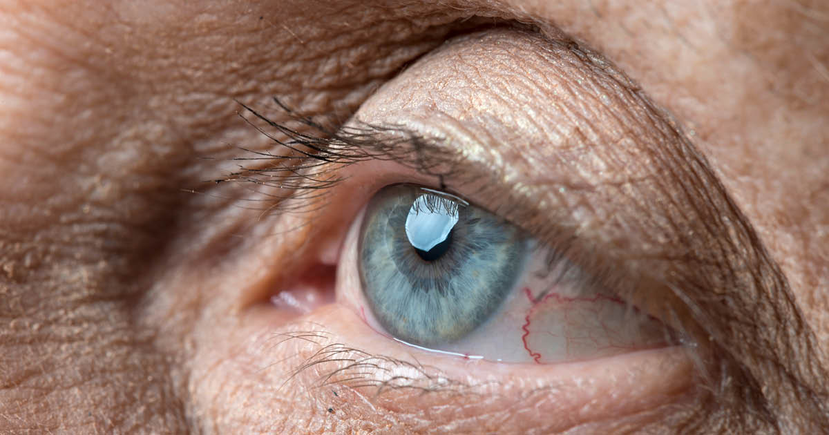 Cataract surgery leads to ‘transient’ macular changes in AMD