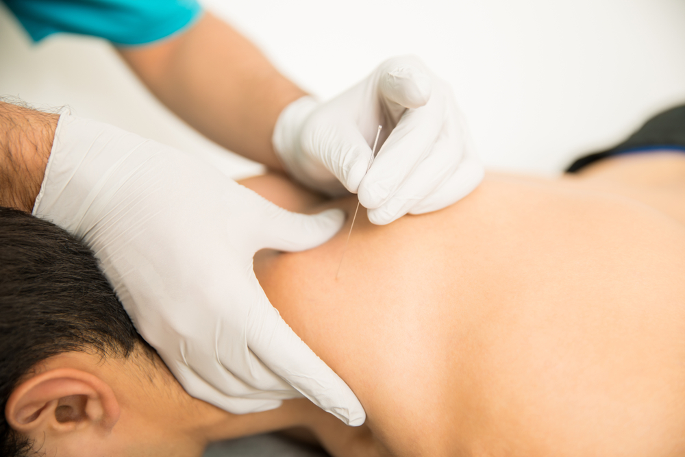 Unlocking Muscle Pain with Dry Needling