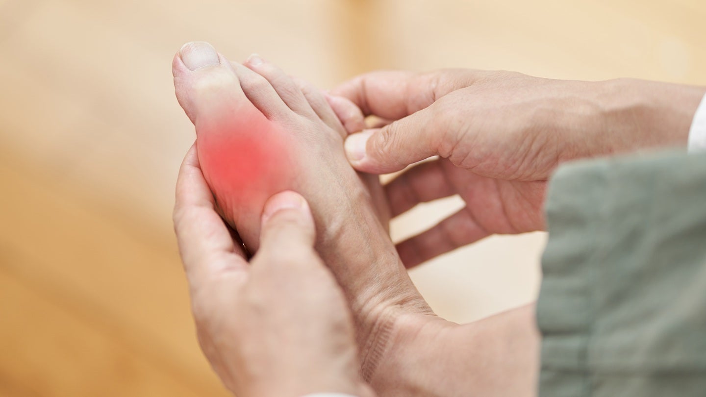 Arthrosi secures 3m to complete development of gout therapy