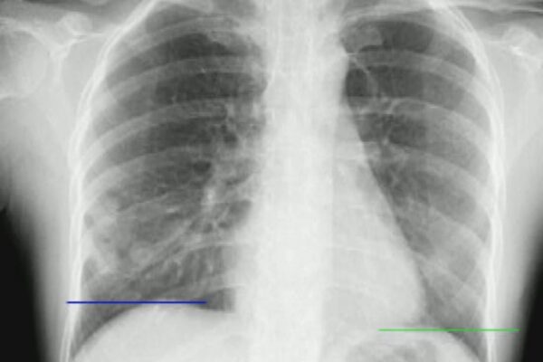 Dynamic Chest Radiography Promising for Diagnosis of Wheezing-Related Respiratory Failure: Case Reports
