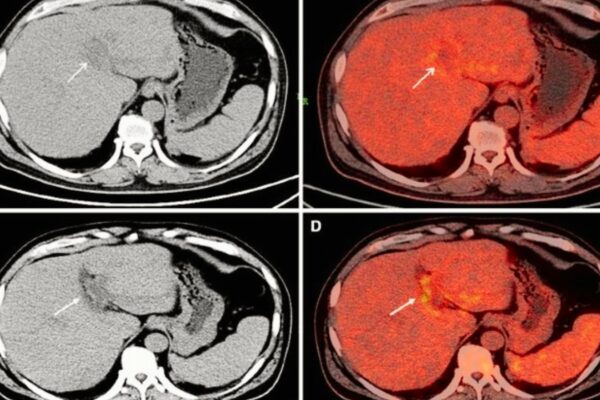 Engineered Stone silicosis associated with strong metabolic activity and extrathoracic lymphadenopathies: Study