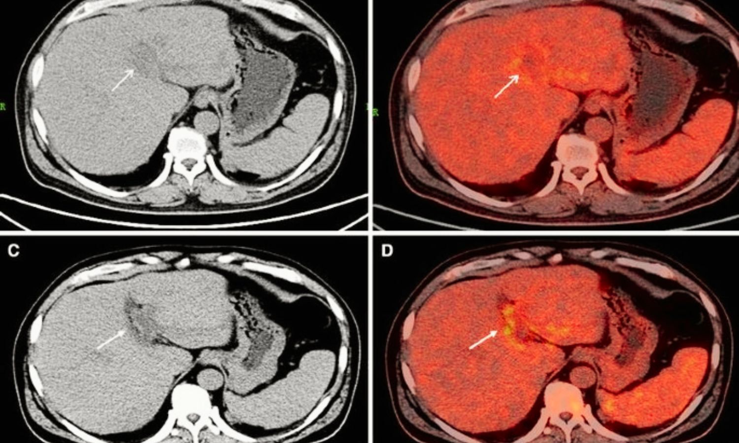 Engineered Stone silicosis associated with strong metabolic activity and extrathoracic lymphadenopathies: Study