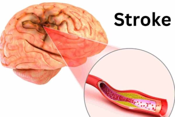 Anxiety Strongly Linked to Cognitive Impairment After Hemorrhagic Stroke: Study