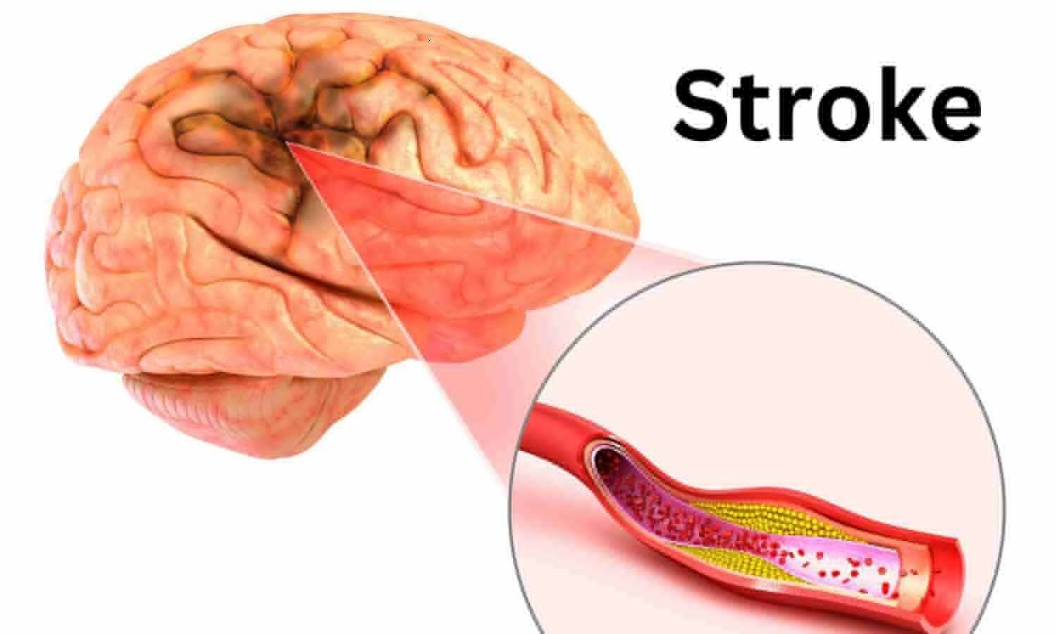 Anxiety Strongly Linked to Cognitive Impairment After Hemorrhagic Stroke: Study
