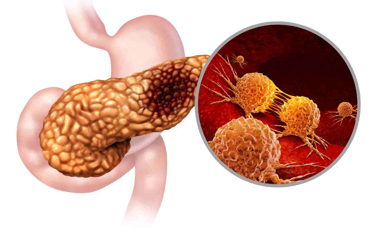 AI Detects Pancreatic Cancer More Accurately Than Radiologists, Finds Research