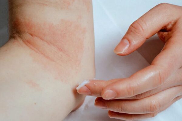 Baricitinib + TCS Outperforms Azathioprine in Moderate-to-Severe Atopic Dermatitis: Study