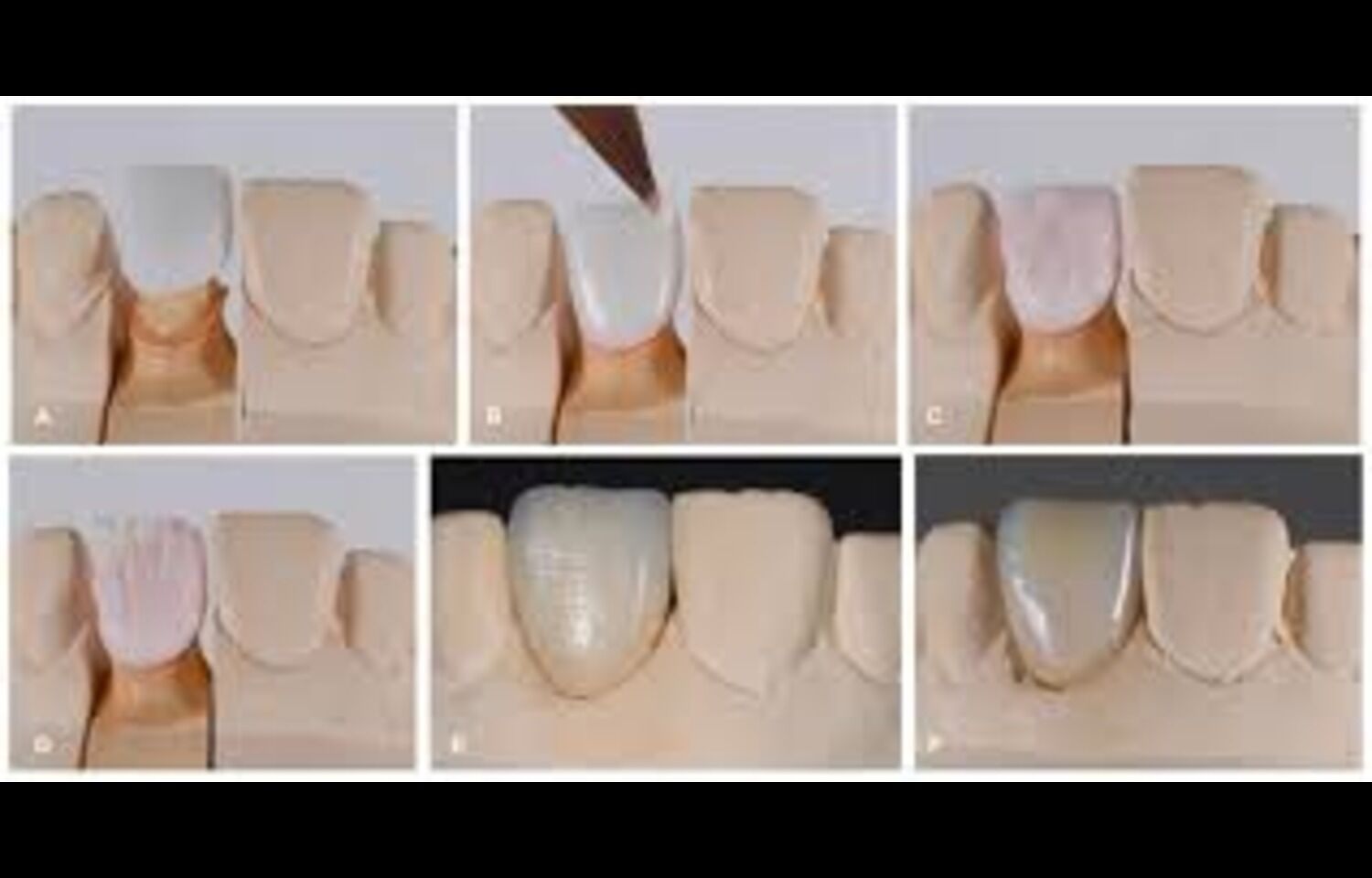 Ceramic Crowns Show Faster Completion with Comparable Outcomes to Cast Crowns: Study