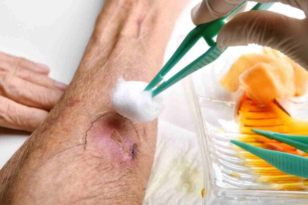 Smart hydrogel mimics skin repair to accelerate diabetic wound healing, suggests research