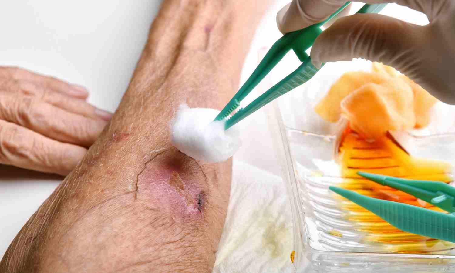Smart hydrogel mimics skin repair to accelerate diabetic wound healing, suggests research