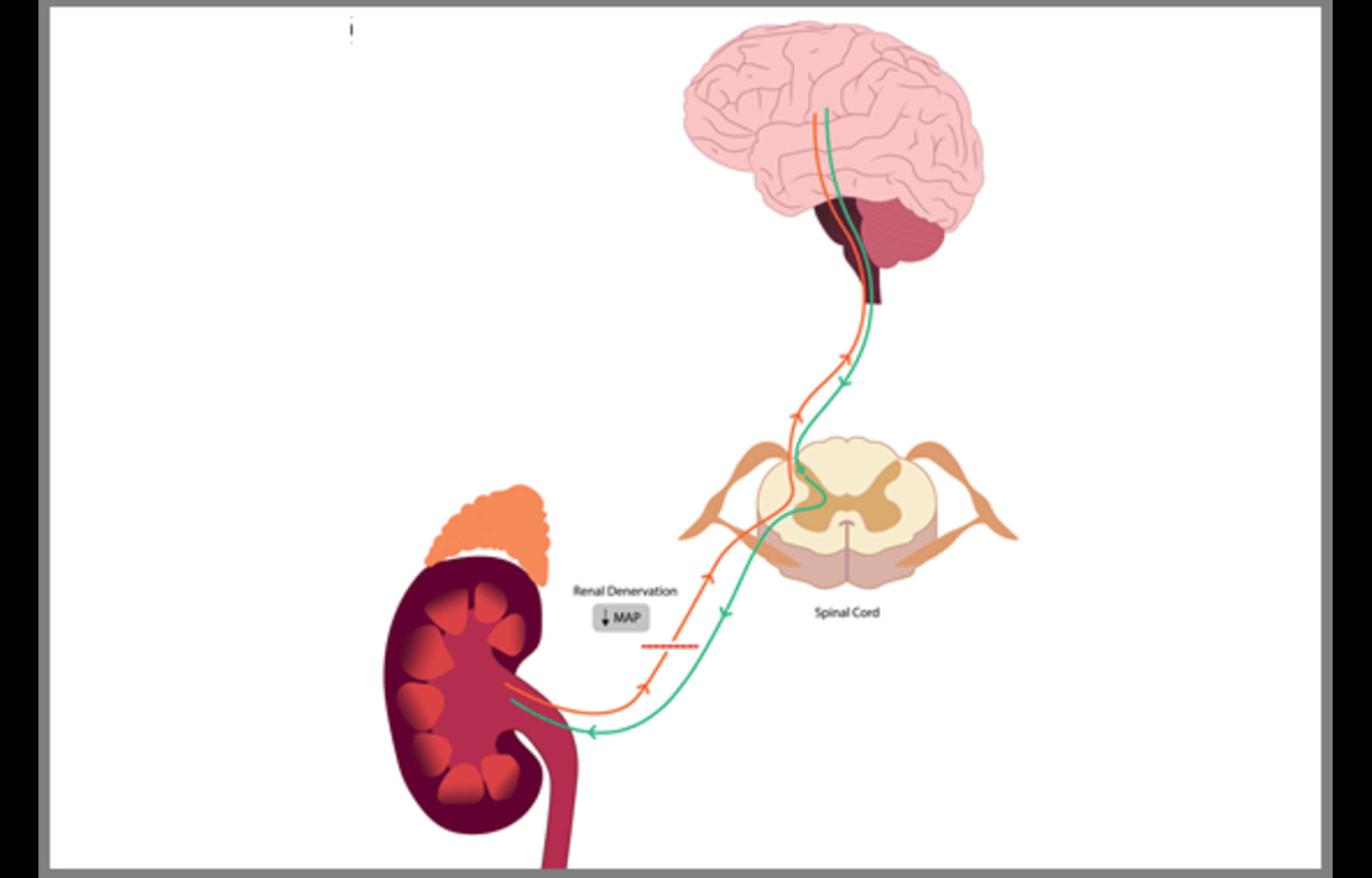 Radiofrequency Renal Denervation effective on long term basis among Patients With and Without CKD: Study