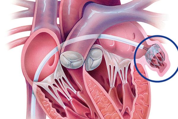 Indian Researchers Redefine Role of Left Atrial Appendage in Stroke Prevention: Apollo Medicine Review