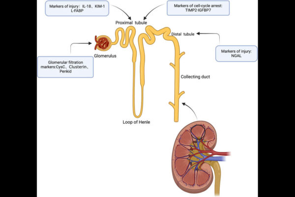 Angiotensinogen as a Predictive Biomarker for AKI and CKD After AMI: Study