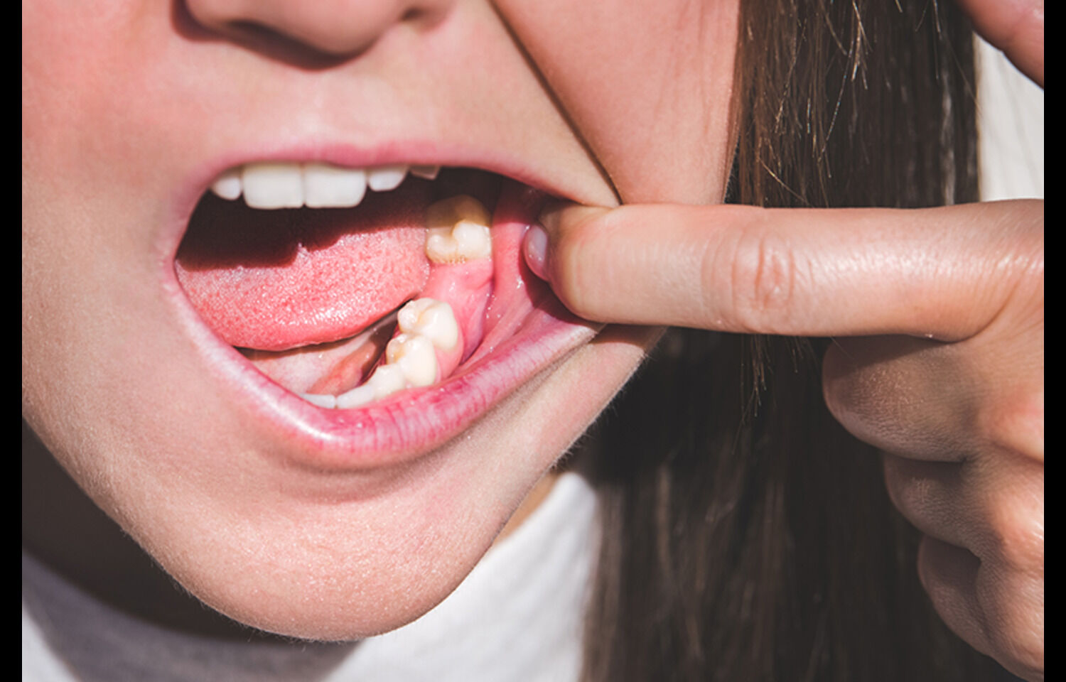 Tooth Loss Raises Cause-Specific Mortality Risk, But Prostheses May Reduce It: Study